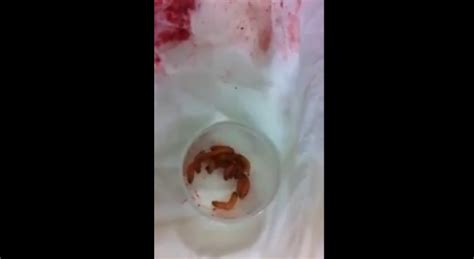 maggots in vagina